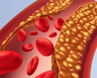 bloghigh-cholesterol-levels