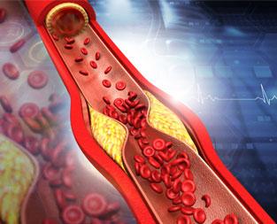 blog/what-is-ldl-cholesterol-in-a-blood-test